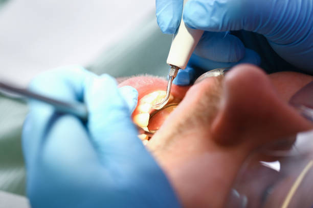 Best Emergency Wisdom Teeth Removal in Tustin, CA